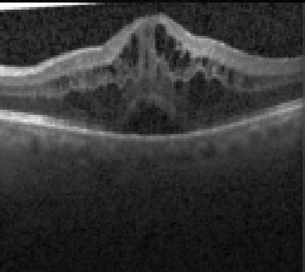 oct macula study, the diagnosis is hidden until you answer