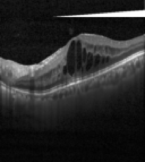 oct macula study, the diagnosis is hidden until you answer