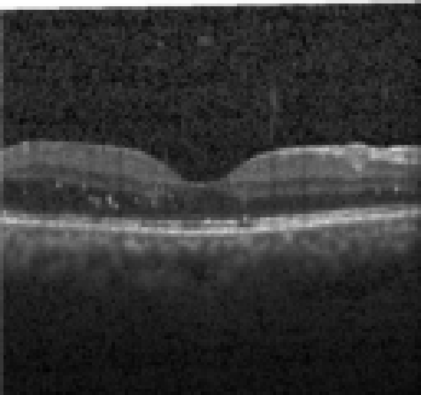 oct macula study, the diagnosis is hidden until you answer