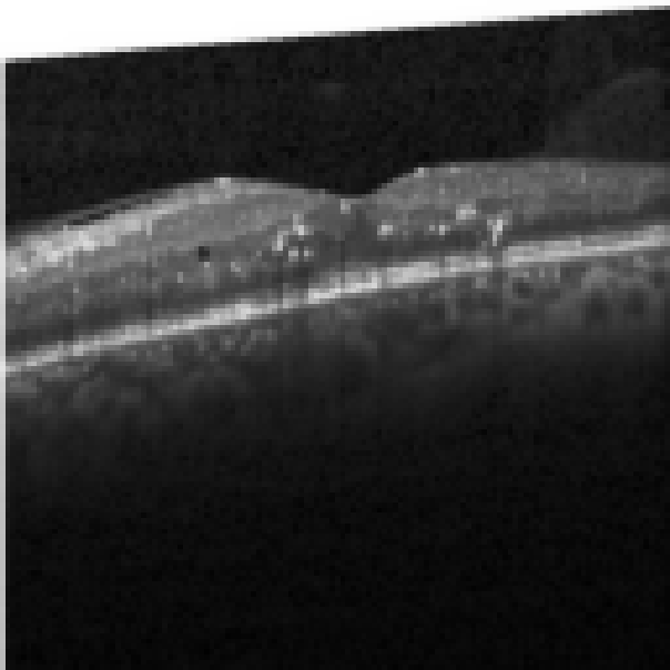 oct macula study, the diagnosis is hidden until you answer