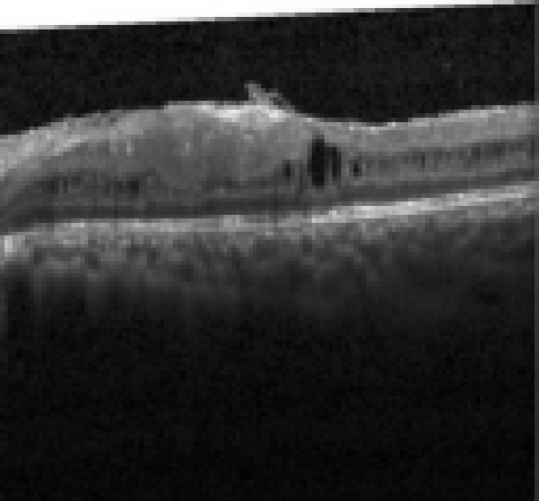 oct macula study, the diagnosis is hidden until you answer