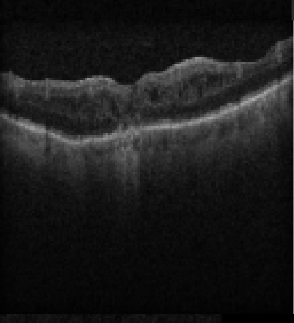 oct macula study, the diagnosis is hidden until you answer