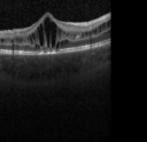 oct macula study, the diagnosis is hidden until you answer