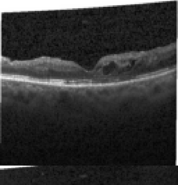 oct macula study, the diagnosis is hidden until you answer