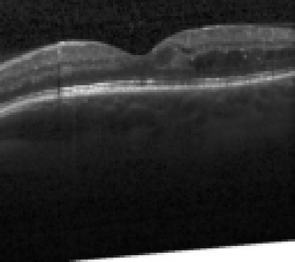 oct macula study, the diagnosis is hidden until you answer