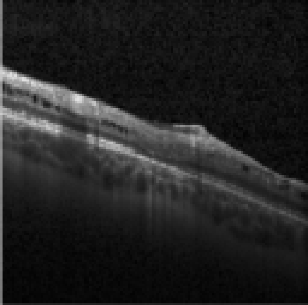 oct macula study, the diagnosis is hidden until you answer