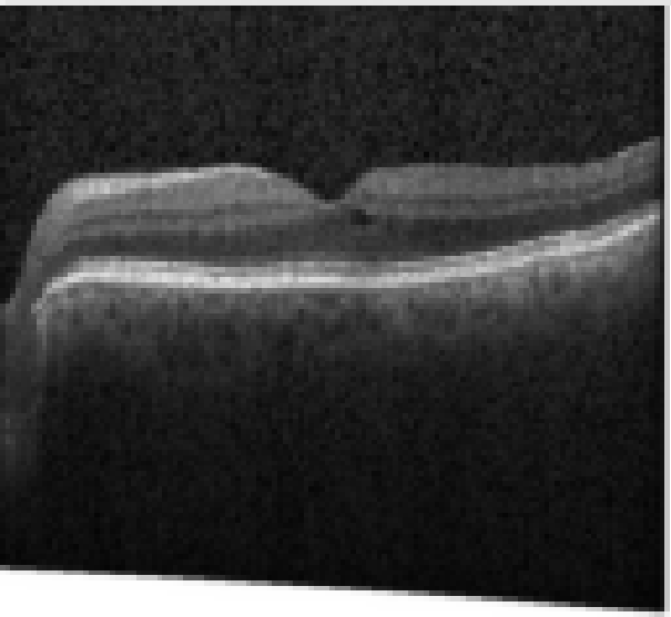 oct macula study, the diagnosis is hidden until you answer