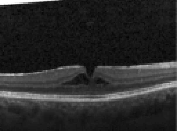 oct macula study, the diagnosis is hidden until you answer