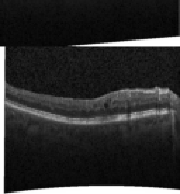oct macula study, the diagnosis is hidden until you answer