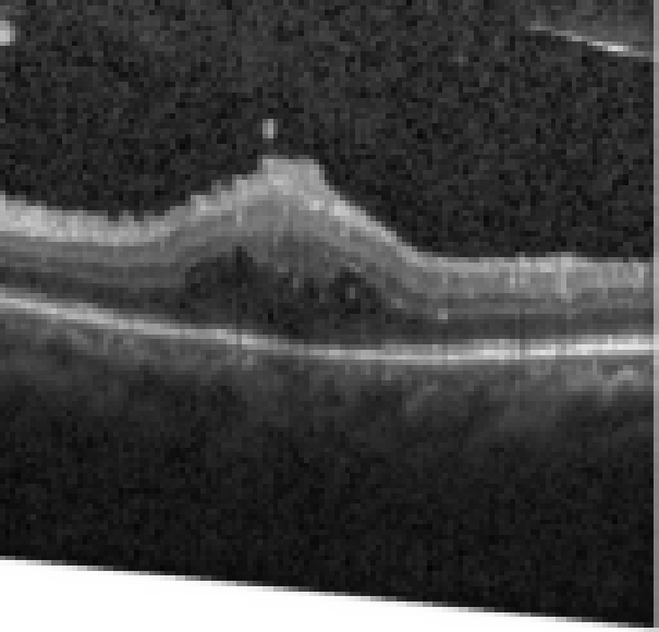oct macula study, the diagnosis is hidden until you answer