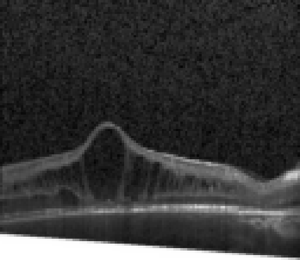 oct macula study, the diagnosis is hidden until you answer