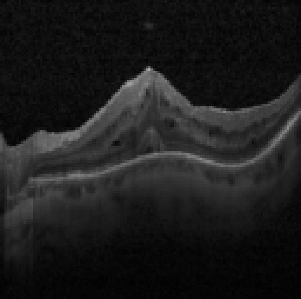 oct macula study, the diagnosis is hidden until you answer