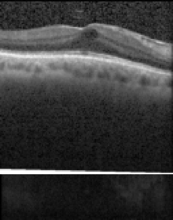 oct macula study, the diagnosis is hidden until you answer