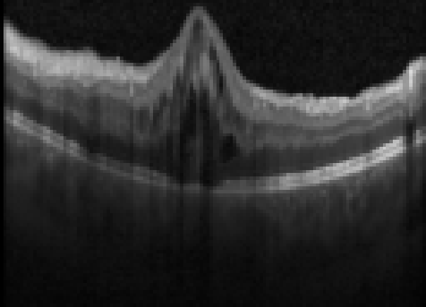 oct macula study, the diagnosis is hidden until you answer