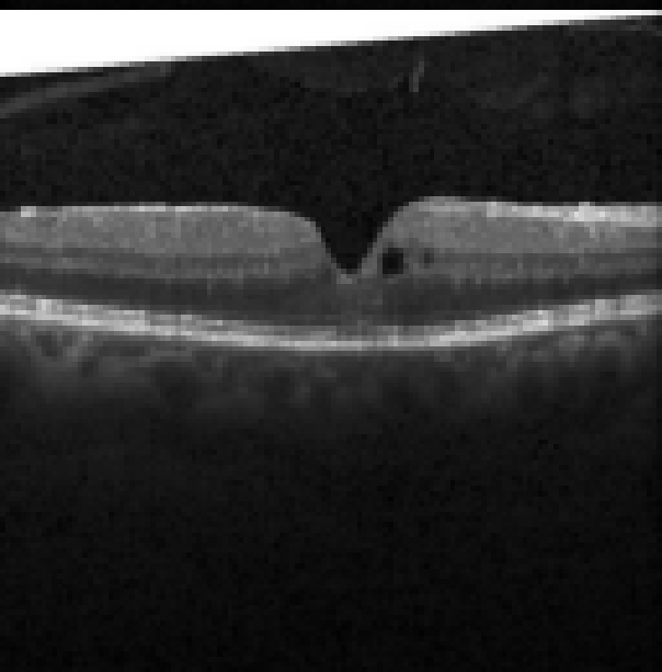 oct macula study, the diagnosis is hidden until you answer