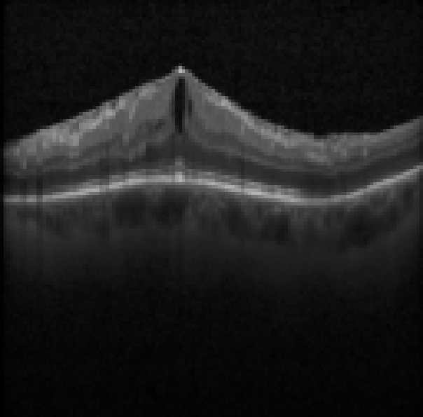 oct macula study, the diagnosis is hidden until you answer