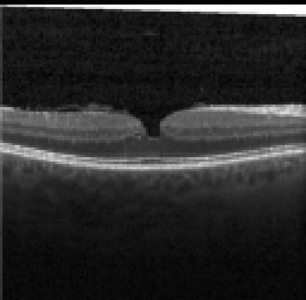 oct macula study, the diagnosis is hidden until you answer