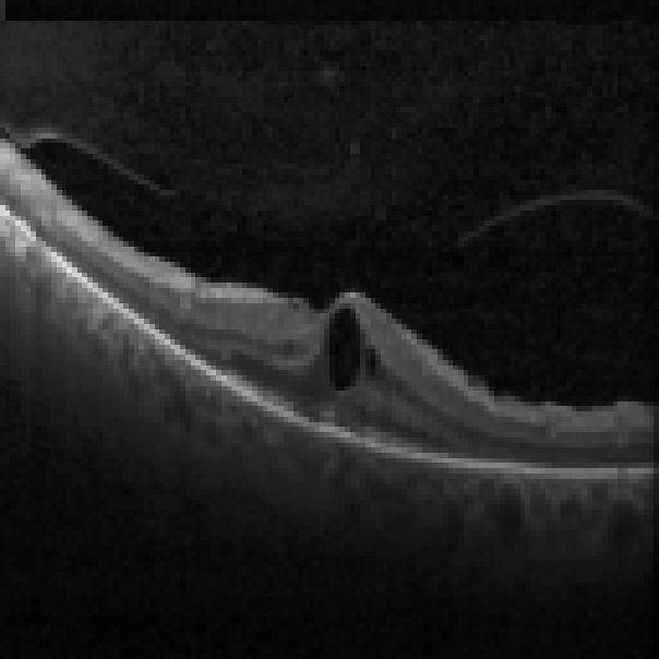 oct macula study, the diagnosis is hidden until you answer