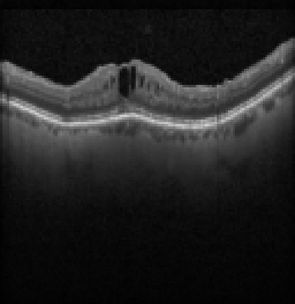 oct macula study, the diagnosis is hidden until you answer