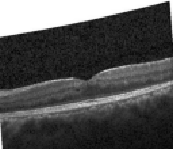 oct macula study, the diagnosis is hidden until you answer