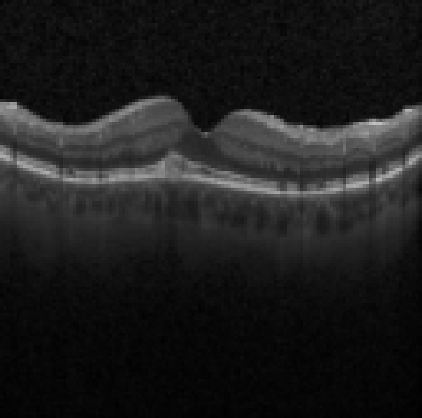 oct macula study, the diagnosis is hidden until you answer