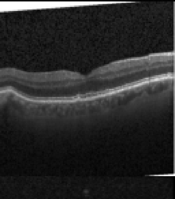 oct macula study, the diagnosis is hidden until you answer