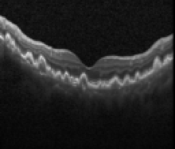 oct macula study, the diagnosis is hidden until you answer