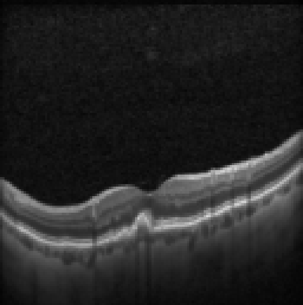 oct macula study, the diagnosis is hidden until you answer
