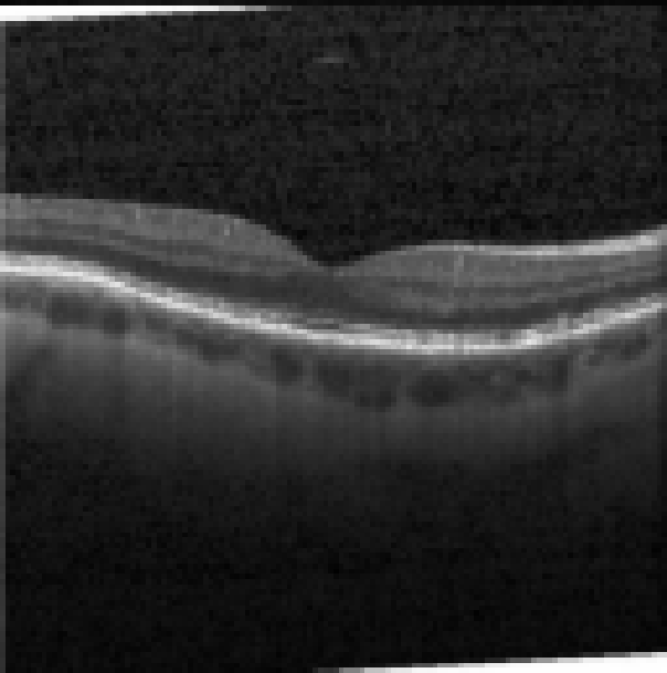 oct macula study, the diagnosis is hidden until you answer