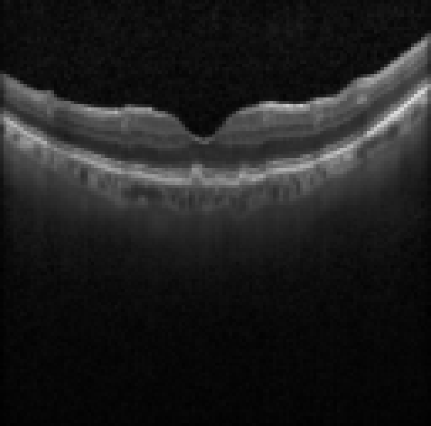 oct macula study, the diagnosis is hidden until you answer