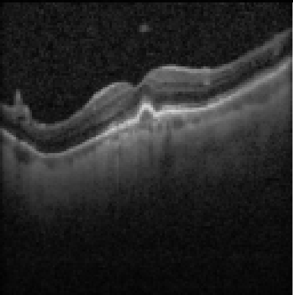 oct macula study, the diagnosis is hidden until you answer