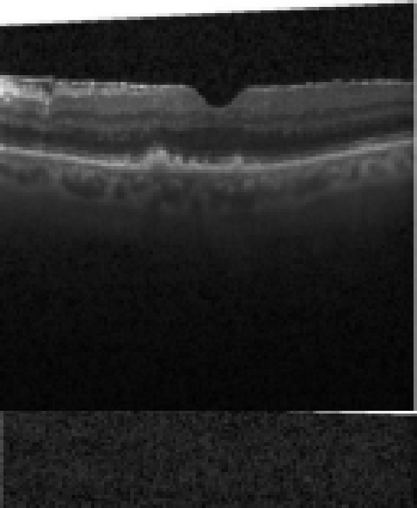 oct macula study, the diagnosis is hidden until you answer