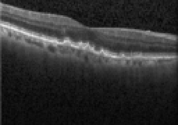 oct macula study, the diagnosis is hidden until you answer