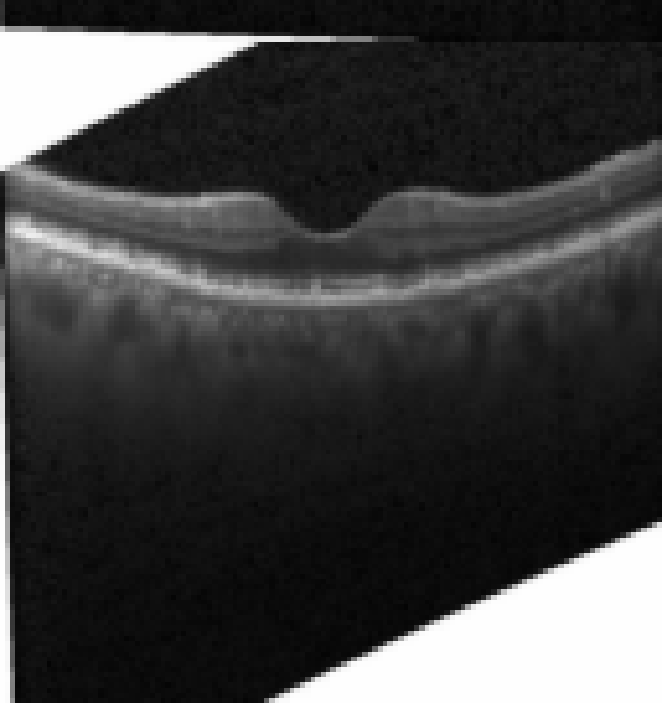 oct macula study, the diagnosis is hidden until you answer