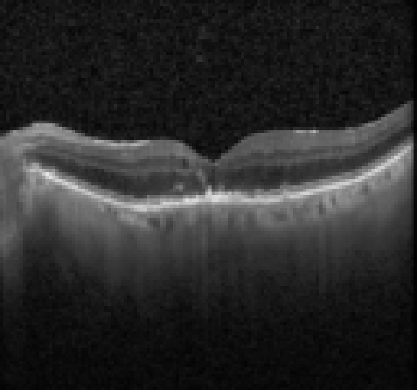 oct macula study, the diagnosis is hidden until you answer
