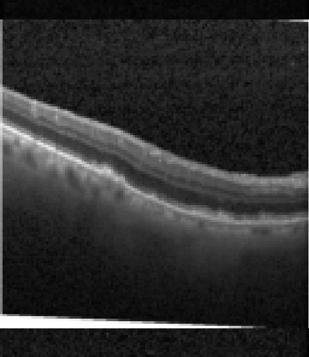 oct macula study, the diagnosis is hidden until you answer
