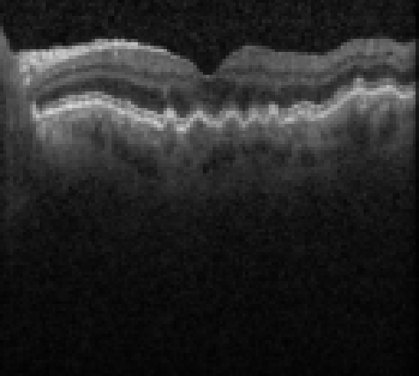 oct macula study, the diagnosis is hidden until you answer