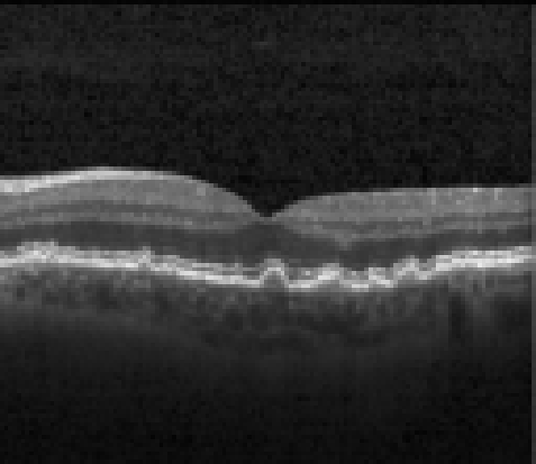 oct macula study, the diagnosis is hidden until you answer