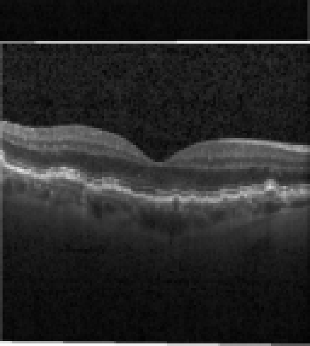 oct macula study, the diagnosis is hidden until you answer