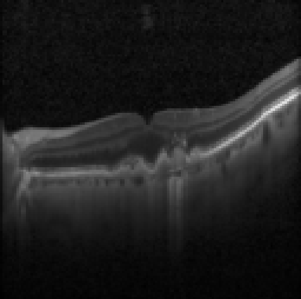 oct macula study, the diagnosis is hidden until you answer