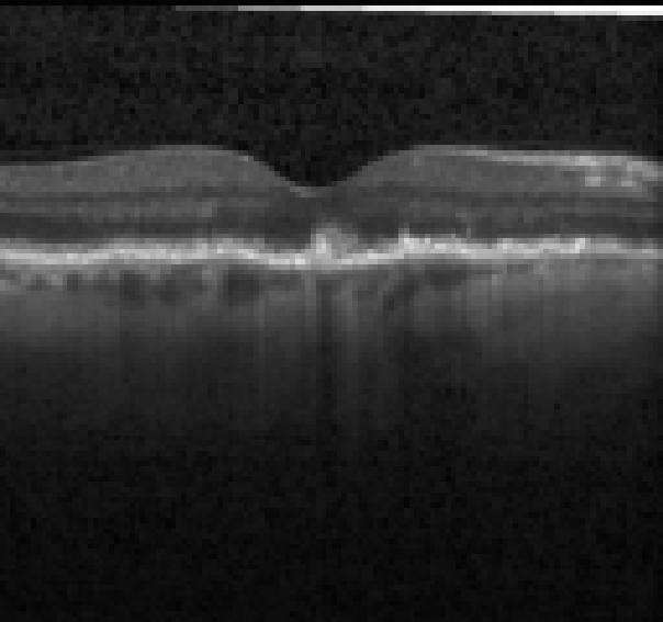 oct macula study, the diagnosis is hidden until you answer