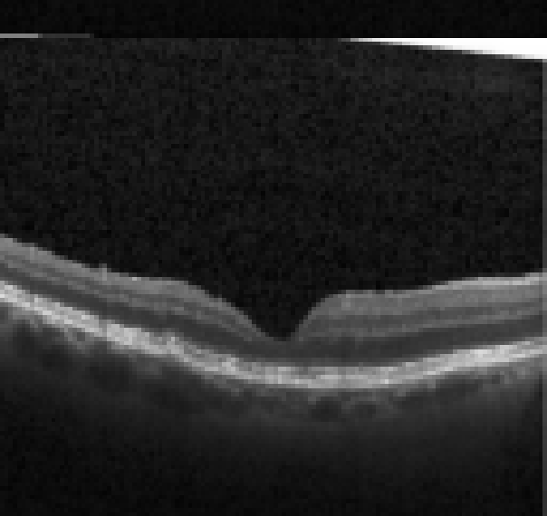 oct macula study, the diagnosis is hidden until you answer