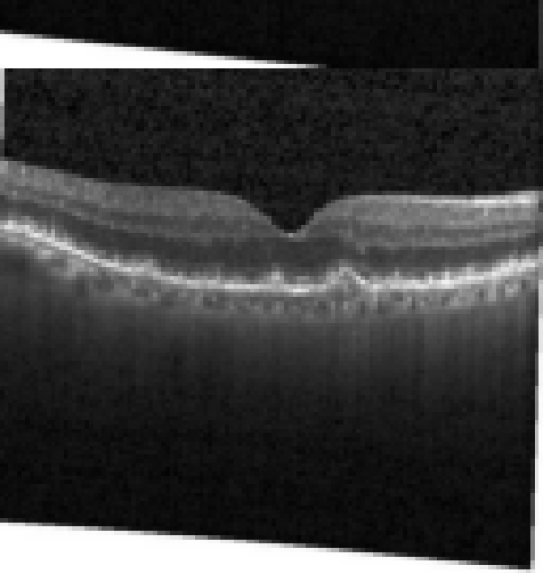 oct macula study, the diagnosis is hidden until you answer