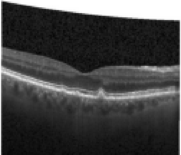 oct macula study, the diagnosis is hidden until you answer