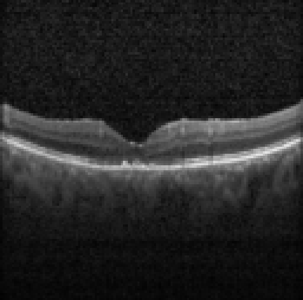 oct macula study, the diagnosis is hidden until you answer