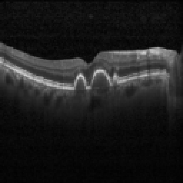 oct macula study, the diagnosis is hidden until you answer