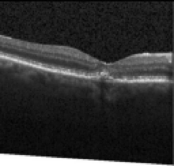 oct macula study, the diagnosis is hidden until you answer