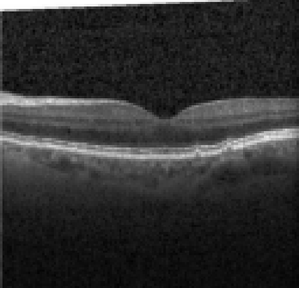 oct macula study, the diagnosis is hidden until you answer