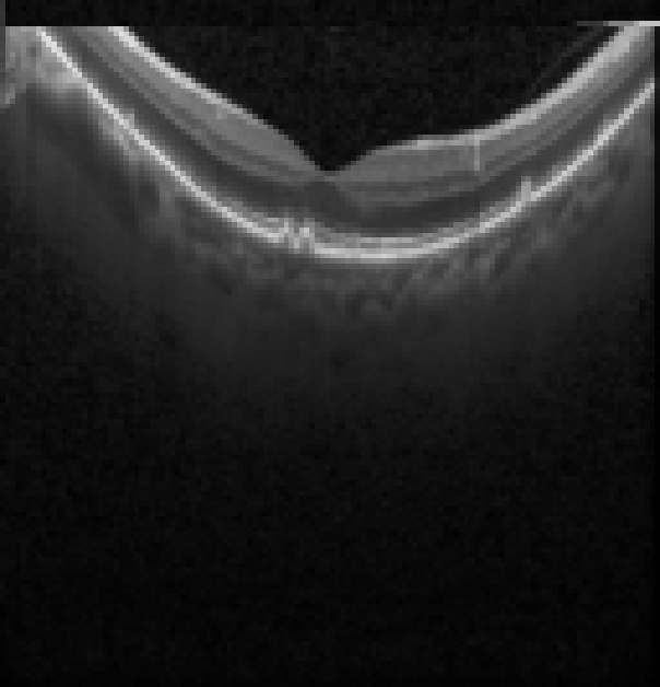 oct macula study, the diagnosis is hidden until you answer