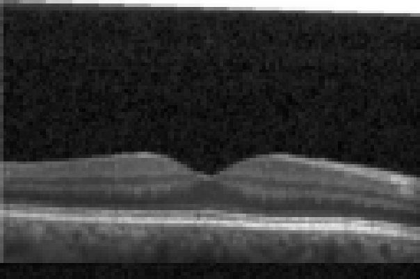 oct macula study, the diagnosis is hidden until you answer